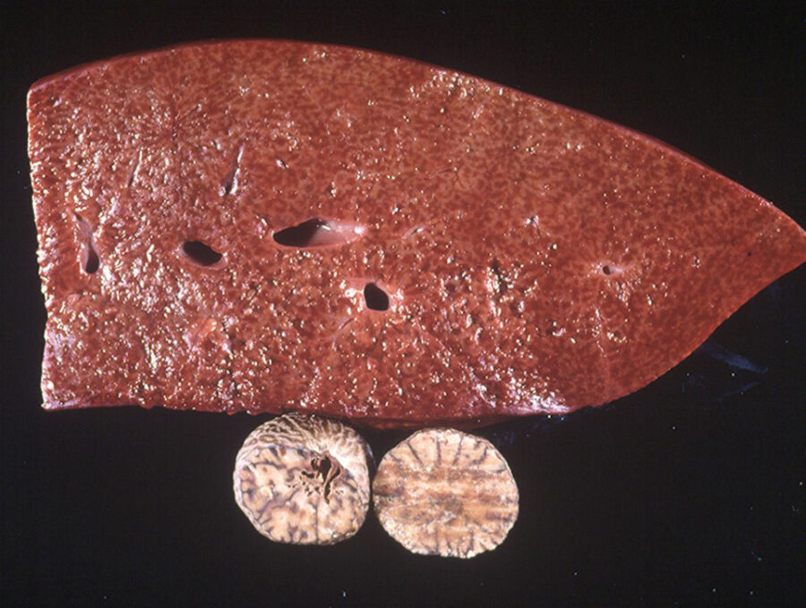 Nutmeg Liver Pathology and Ponies